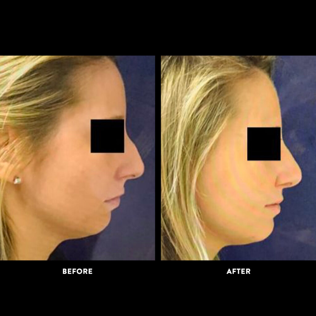 Rhinoplasty before & after