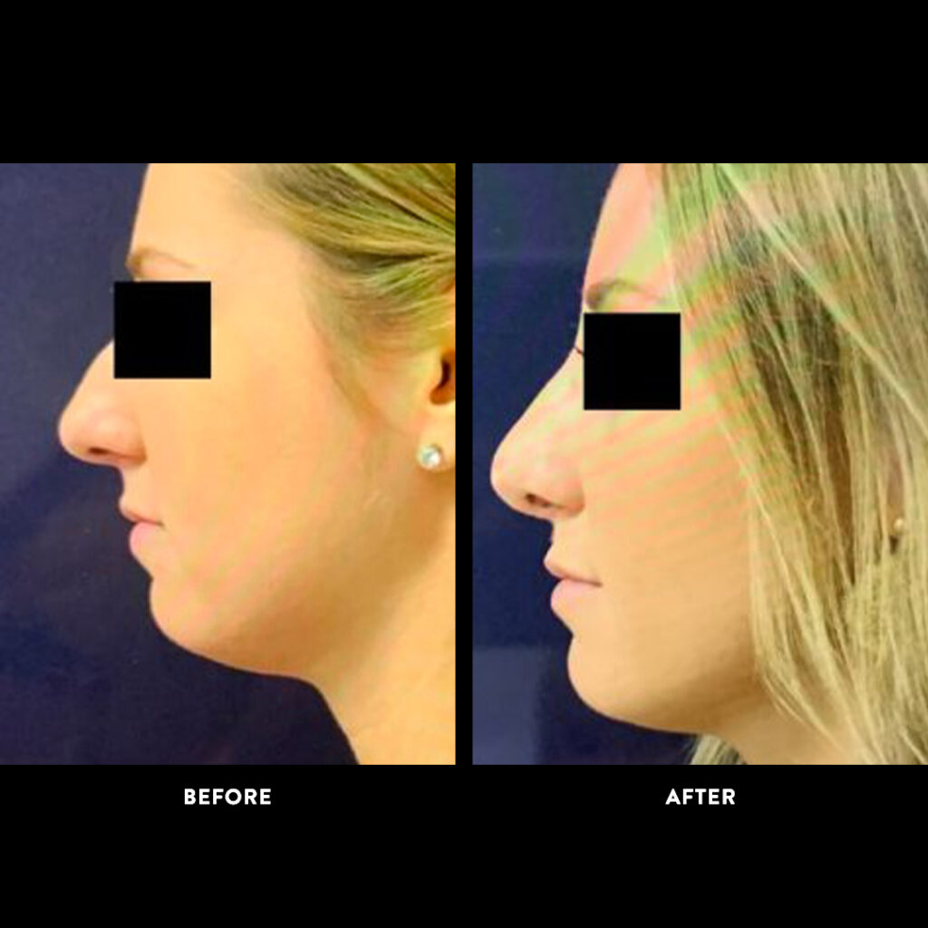 Rhinoplasty before & after photo